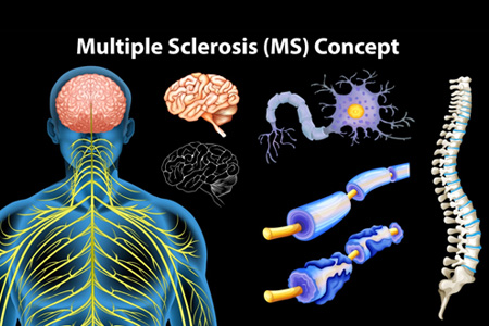 multiple sclerosis therapy