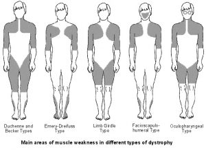 Muscular Dystrophy treatment Specialist