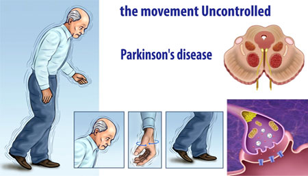 parkinson's disease cure
