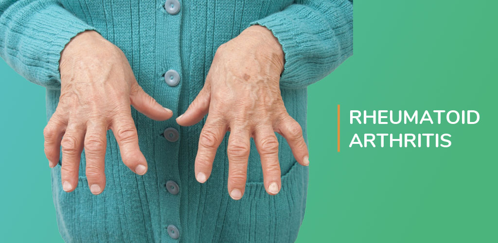 Rheumatoid Arthritis Treatment