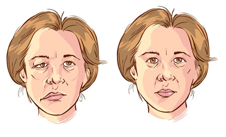 facial palsy treatment