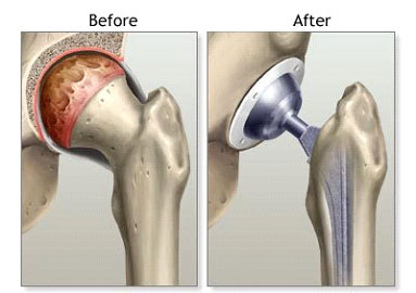 hip fracture treatment
