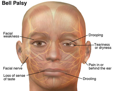 bell palsy treatment exercises