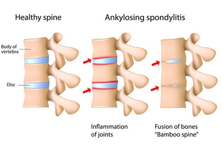 ankylosing spondylitis treatment