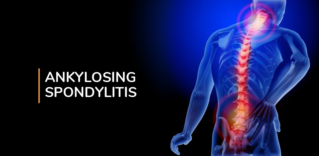Ankylosing Spondylitis treatment