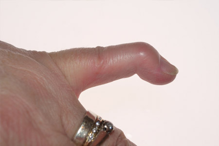 cure for trigger finger without surgery